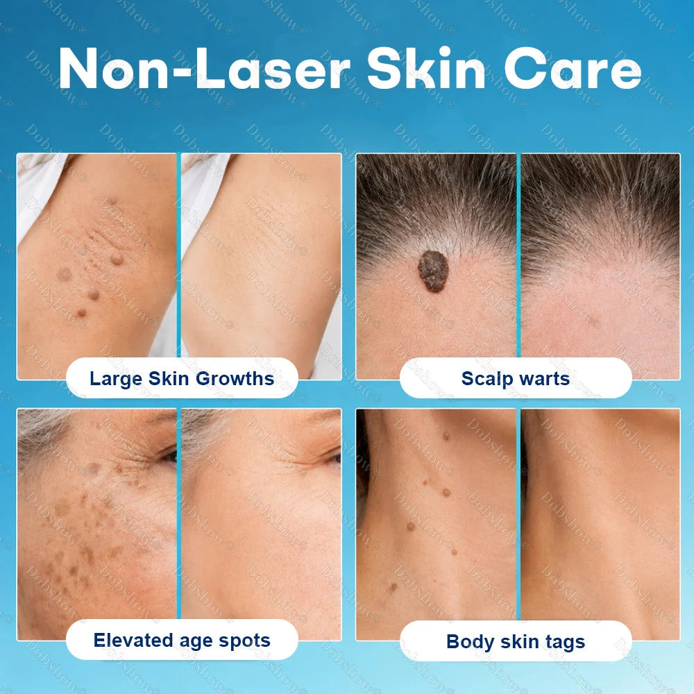 Healrize® 7-Day Blemish Remover, Painless and Scar-Free — Advanced Ballpoint Pen for Skin Tags and Spots