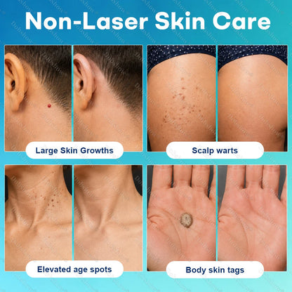 Healrize® 7-Day Blemish Remover, Painless and Scar-Free — Advanced Ballpoint Pen for Skin Tags and Spots