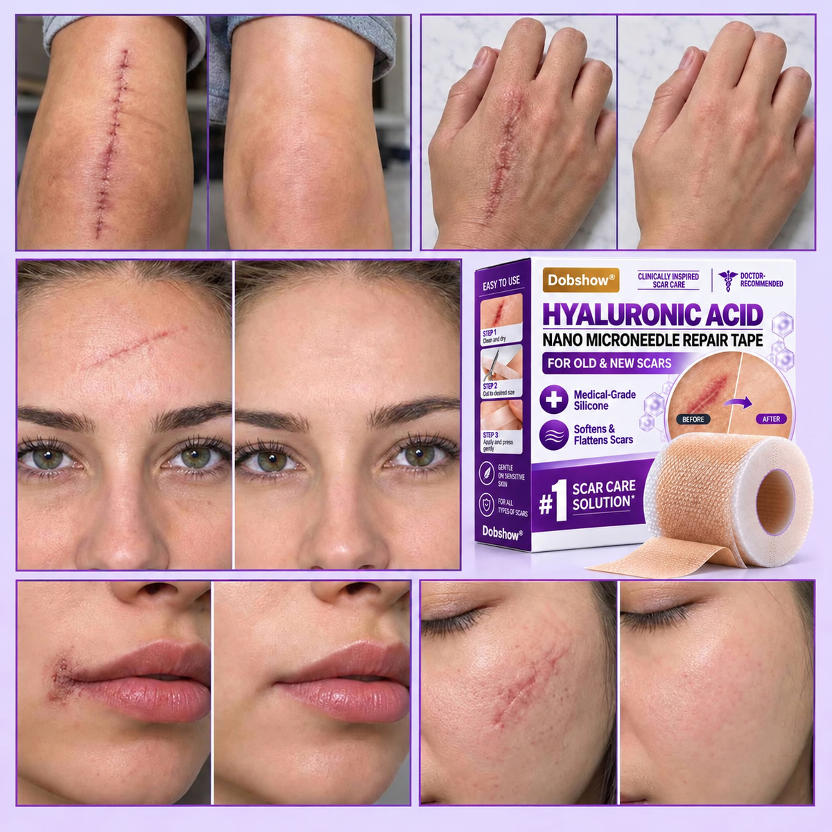 ✅Dobshow®Hyaluronic Acid Nano Microneedle Repair Tape for Surgical, C-Section, Raised & Stubborn Scars🏉