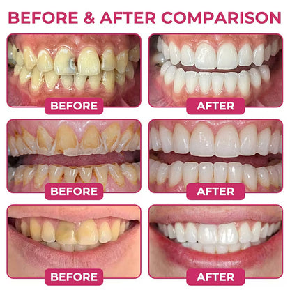 Dobshow® 🦷 DenPerm Cavity-Repair Advanced Enamel Filling Gel
