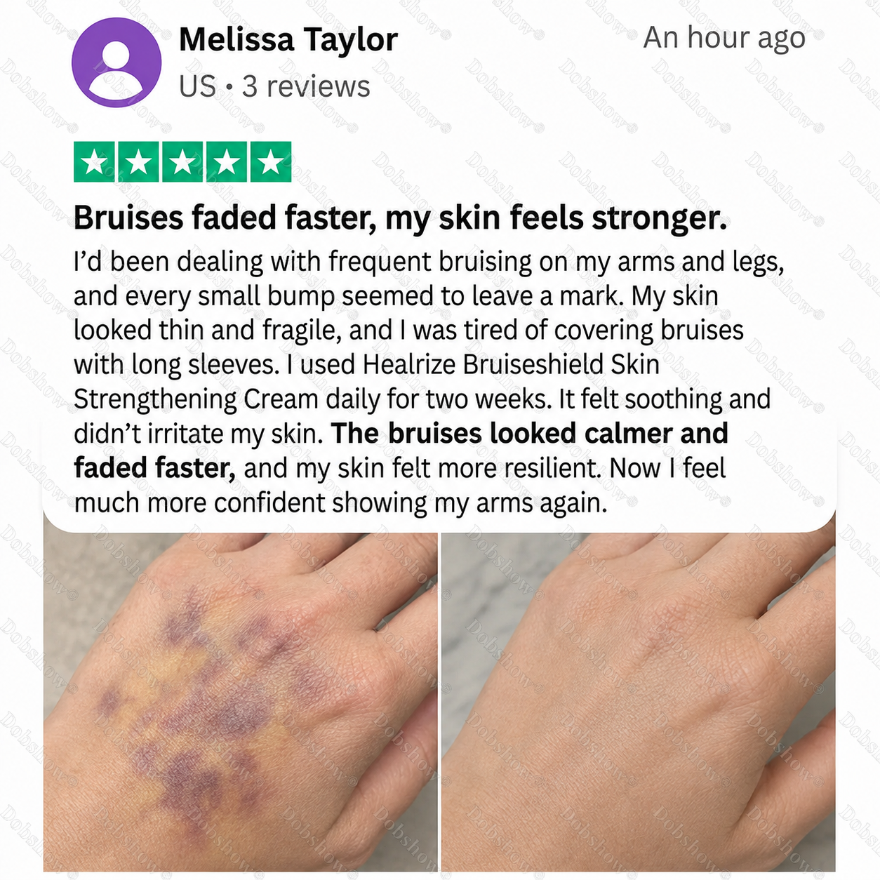 💥500K+ SOLD💕- Dobshow® Bruise Shield & Skin-Strengthening Cream